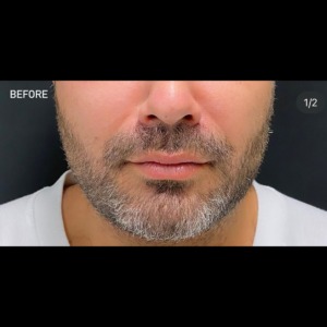 Före och efter buccal fat pad removal